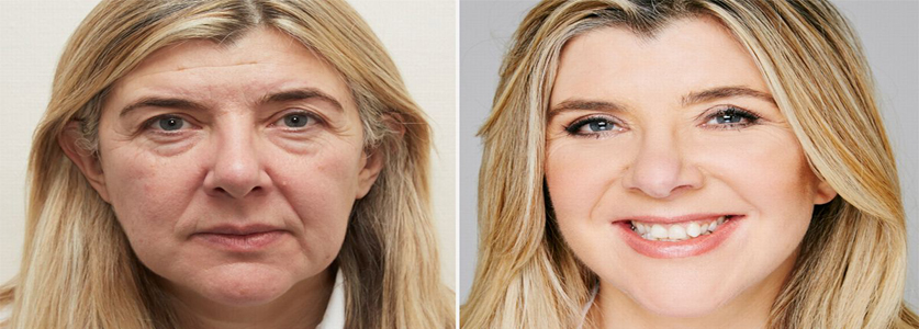 Picture of a before and after face lift surgery